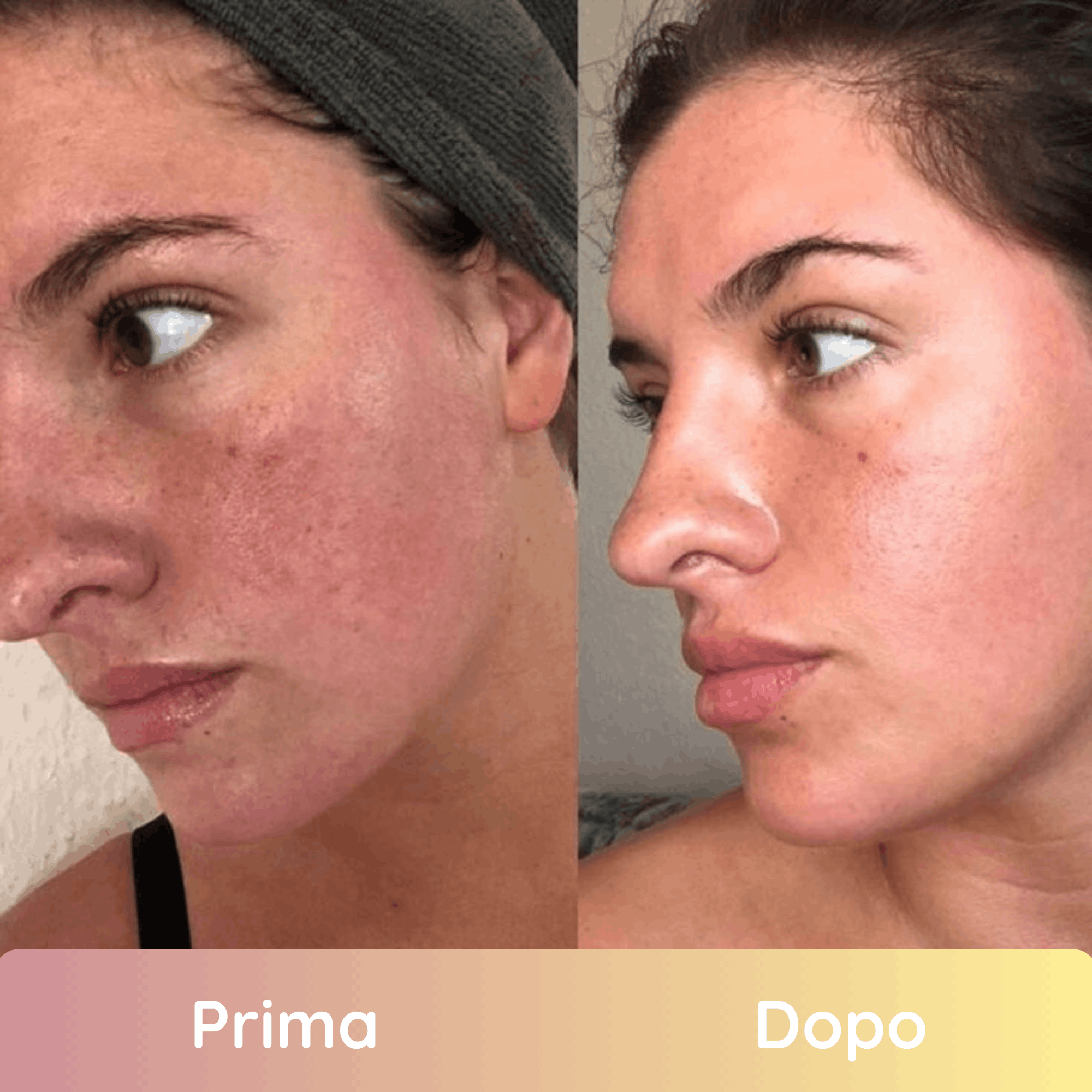 Pads Illuminanti Per Un Viso Uniforme e Giovane in 2 Settimane