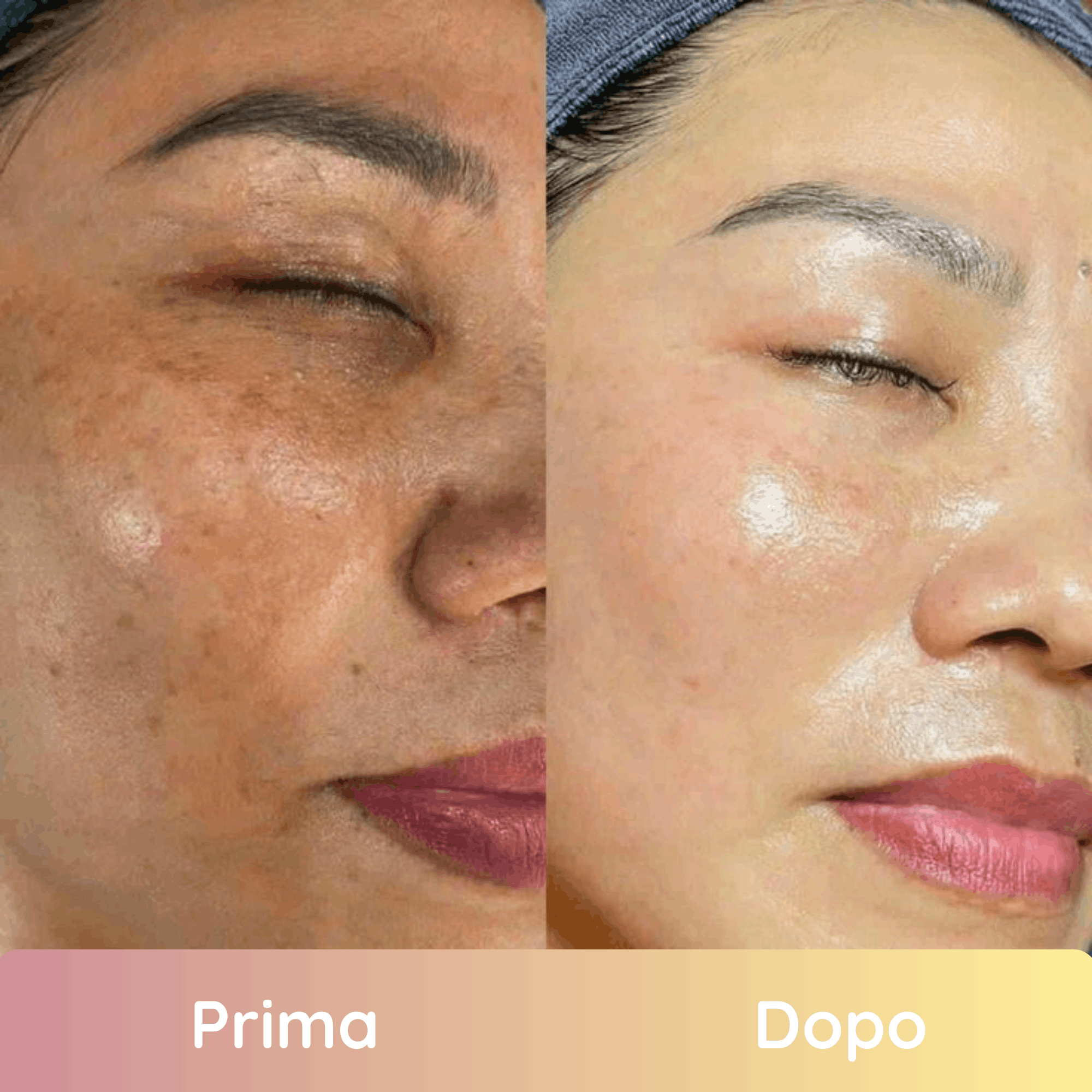 Pads Illuminanti Per Un Viso Uniforme e Giovane in 2 Settimane